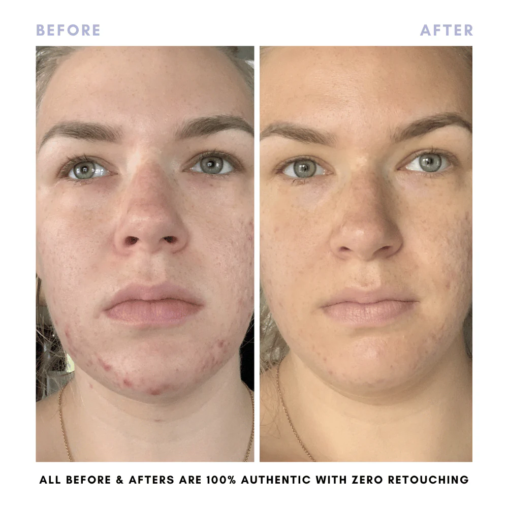 BUNDLE & SAVE! The Balancing Treatment Duo - Image 8